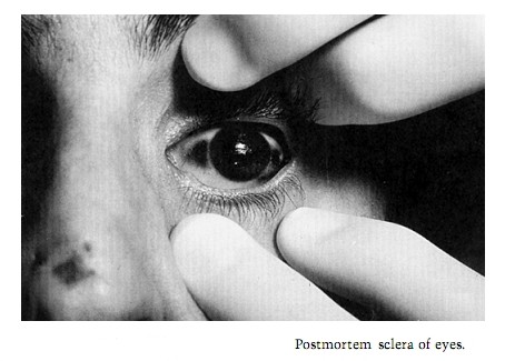 postmortem-sclera
